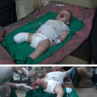 Syria - Children - Injured Child with Amputated Leg - World - 28-1-2013